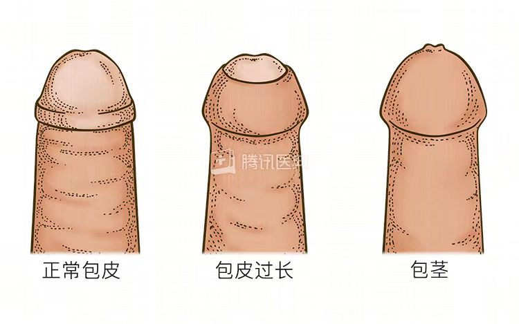 割包皮真的能让时间更持久、更爽,鸡鸡变长吗3 割包皮真的能让时间更持久、更爽,鸡鸡变长吗3