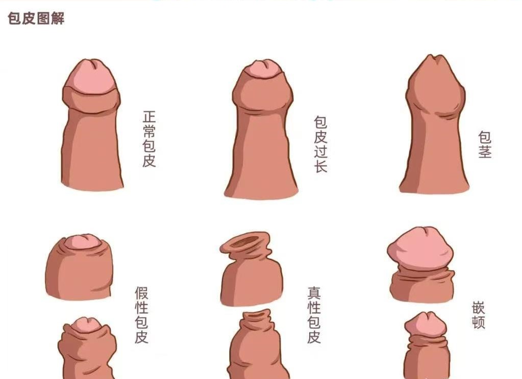 割包皮真的能让时间更持久、更爽,鸡鸡变长吗2 割包皮真的能让时间更持久、更爽,鸡鸡变长吗2
